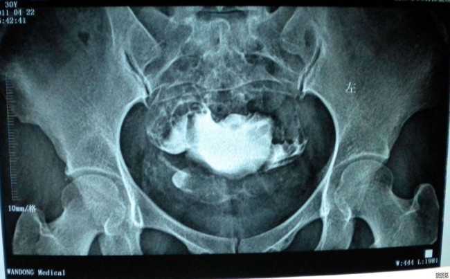 国内医院供卵费用,做三代试管可以解决家族遗性狐臭吗？